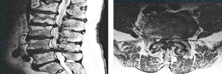 요추 척수 협착을 보이는 측방 (좌측) 및 축상 (우측) MRI 검사